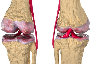 Osteoarthritis of the knee