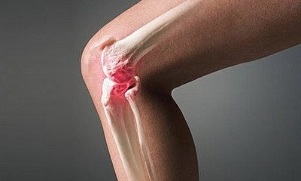 how arthritis differs from osteoarthritis