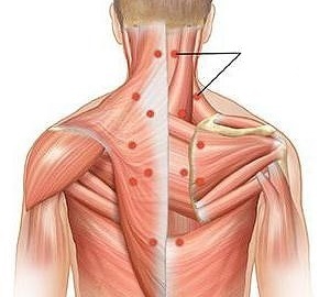 myositis as a cause of back pain