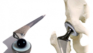 hip joint arthroplasty for osteoarthritis