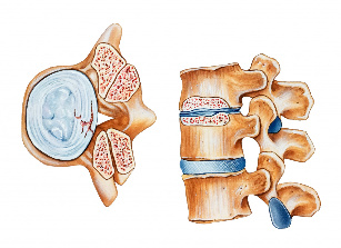 Osteochondrosis