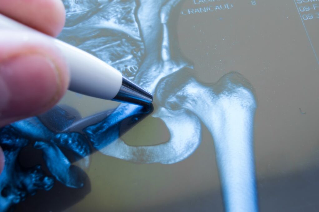 Osteoarthritis of the hip joint on x-ray