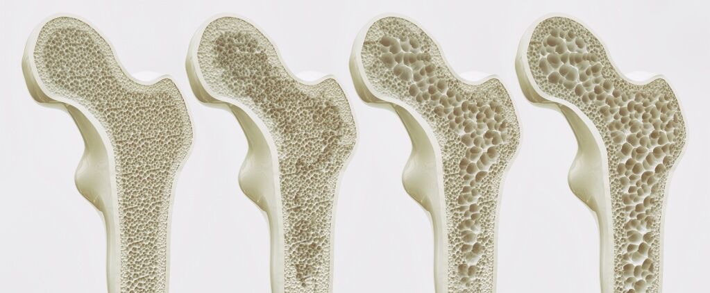 The degree of development of coxarthrosis