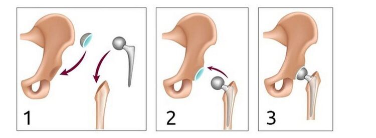 Hip arthroplasty