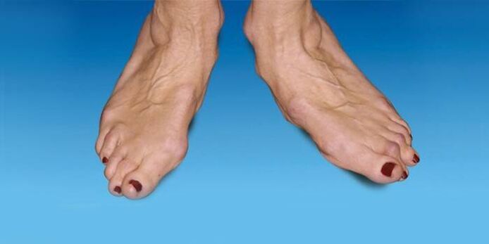 foot deformity with arthrosis of the ankle