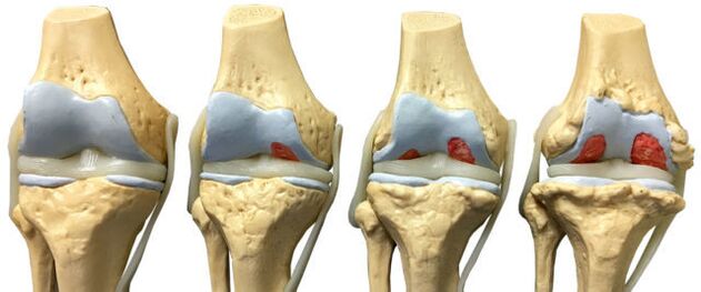 joint damage in the different stages of development of osteoarthritis of the ankle