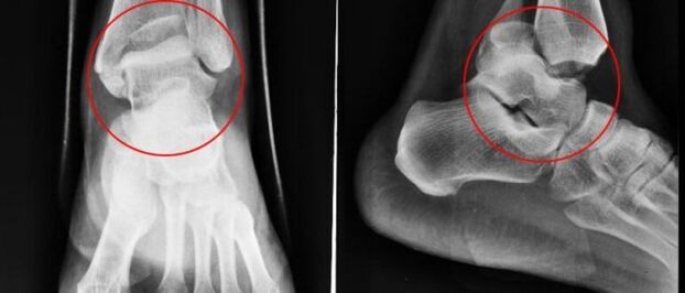 x-ray for osteoarthritis of the ankle