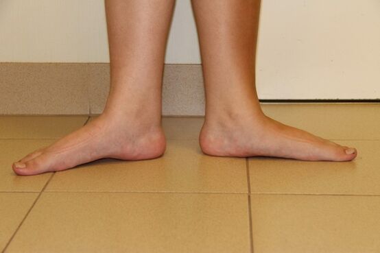 Sometimes the cause of neck arthritis is flat feet