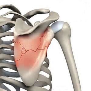 A fracture of the scapula is one of the causes of severe pain.